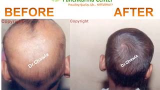 Alopecia Universalis Treated Succesfully [upl. by Anikas]