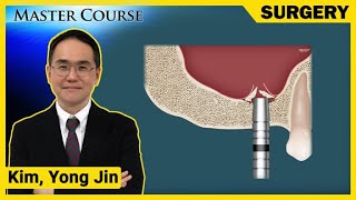 Master Course Season2  SURGERY Complications related to Crestal approach Sinus lifting [upl. by Annatnas644]