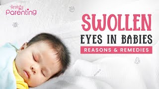 Swollen Eyes in Babies  Causes and Remedies [upl. by Tabshey]