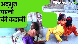 अद्भुत बहनों की कहानी  Spider Sisters  A Medical Wonder  Body Bizarre  Discovery Plus India [upl. by Anaila]