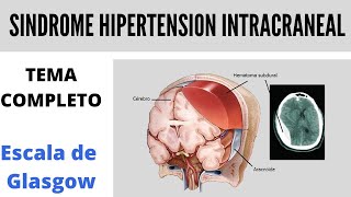 SINDROME DE HIPERTENSION INTRACRANEAL  Glasgow [upl. by Shepard841]