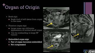 03 Approach to Peritoneal and Retroperitoneal Masses [upl. by Ayatnwahs571]