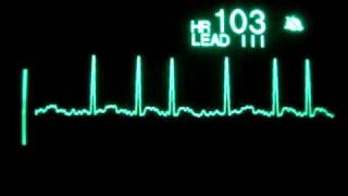 Atrial Fibrillation [upl. by Downe292]