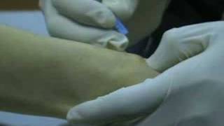 Ganglion Cyst Removal with Acupuncture [upl. by Adriell]