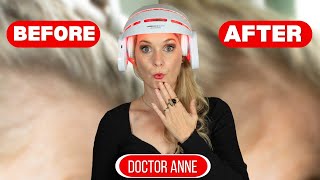 Does the CurrentBody LED Hair Growth Helmet Really Work Doctor Anne’s 6Month Review [upl. by Beard430]