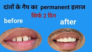 दांतो के गैप को कैसे ठीक करेंpermanent teeth gap close just in 2 daysteeth spacingE max crown [upl. by Ahseyi]