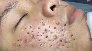 Big Cystic Acne Blackheads Extraction Blackheads amp Milia Whiteheads Removal Pimple Popping  4101 [upl. by Amie]