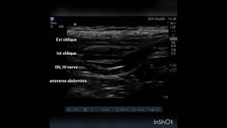 Ilioinguinal and iliohypogastric nerve block for hernia repair [upl. by Fish]