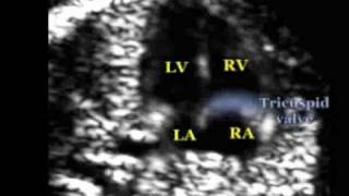 Fetal Medicine Foundation  Tricuspid flow [upl. by Resee]