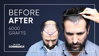 Hair Transplant in Turkey  Results  Dr Acar  Cosmedica Clinic [upl. by Adnoma]