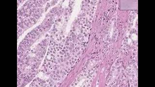 Histopathology ProstateAdenocarcinoma Gleason grade 4 [upl. by Eniamahs]