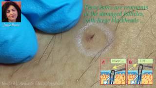 Josefa Blackheads and Ingrown Hairs [upl. by Ahmad]