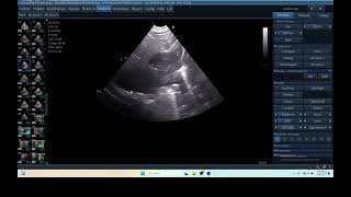 IQ 290 TFAST LUNG MASS ULTRASOUND ICP CPP ECHOPAC ANALYSIS 00 [upl. by Rothwell682]