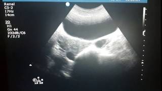 Para Ovarian Cyst [upl. by Enaud]