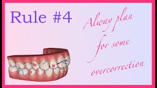 Overcorrection and whereabouts  Invisalign Mini Course 5 of 8 [upl. by Odnanreh]