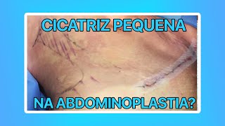 CICATRIZ PEQUENA NA ABDOMINOPLASTIA O QUE VOCÊ PRECISA SABER  CIRURGIA PLÁSTICA [upl. by Oxley]