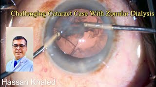 Challenging Cataract Case With Zonular Dialysis [upl. by Agn]