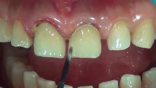 Staining and glazing CEREC crowns inside the patients mouth one visit only [upl. by Oremodlab]