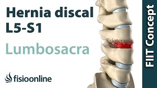 Hernia discal lumbar entre la L5 y S1 o quinta vértebra lumbar y el sacro [upl. by Nomyaw385]