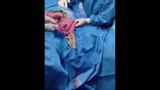 Trigger Warning Ascaris Lubricoides Intestinal Worms Parasite Removal Surgery [upl. by Tabb]