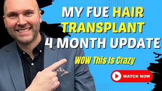 My FUE Hair Transplant 4 Months Update WOW This Is Crazy [upl. by Bessie]