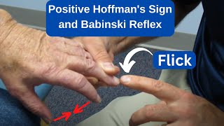 Positive Hoffmans Sign and Babinski Reflex in an MS Patient [upl. by Frissell338]