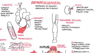 Atherosclerosis  Pathophysiology [upl. by Claman]