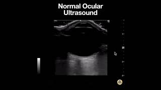 Normal Ocular Ultrasound Anatomy [upl. by Amitaf881]