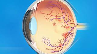 Vitrectomie pour hémorragie du vitré  Opération de lhémorragie intravitréenne [upl. by Sirtimid]