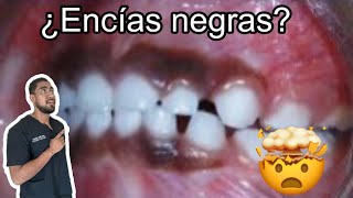 Que son esas manchas en las encías   Melanosis gingival [upl. by Aiz]