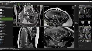 Webinar Summer Session 2024 The Clinical Impact of Fetal Cardiac MRI [upl. by Eicam362]