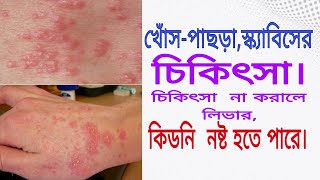 Scabeis বা খোঁসপাচড়া রোগের চিকিৎসা এবং করনীয় কি treatment of scabies [upl. by Saylor182]