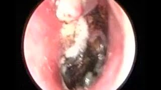 Severe Fungal Ear Infection cleaning by suction irrigation [upl. by Brawner]