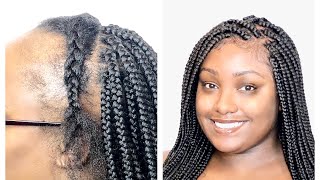 QampA  LACE FRONTAL BOX BRAIDS FOR THINNING HAIR  NO WIG NEEDED PART 2 [upl. by Ferneau752]