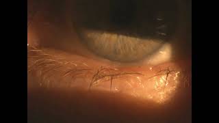 trichiasis misdirected eyelash [upl. by Akemor]