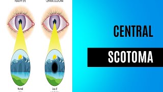 Central Scotoma  Visual Field Disorder [upl. by Carrol958]