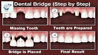 Dental Bridge Procedure Step by Step [upl. by Kurth242]