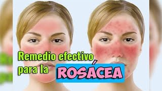 Remedio efectivo para rosácea un solo ingrediente  EcoDaisy [upl. by Annaid]