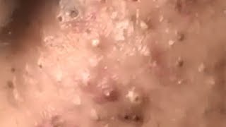 Huge Acne Pimples Blackheads Popping Up Satisfying with Oddly Calm Music [upl. by Ezri]