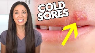 What are COLD SORES amp How To Get Rid of Them [upl. by Roberts]