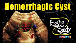 Ovarian Hemorrhagic Cyst  ORADS 2  Ultrasound  Case 306 [upl. by Ixela]