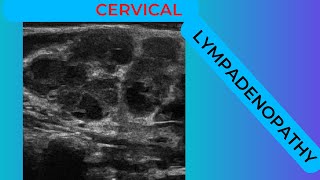 Cervical lymphadenopathy conglomerating nodes on ultrasound scan [upl. by Ahsha]