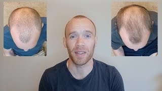 Rosemary Oil for Hair Growth  6 Month Results [upl. by Irovi]