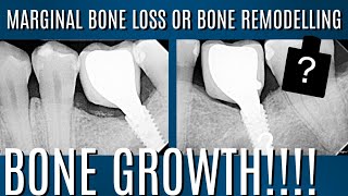 MARGINAL BONE LOSS VS BONE REMODELLING [upl. by Katherina517]