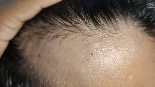 hair regrowth after treatment varanasi banaras treatment [upl. by Eerised534]