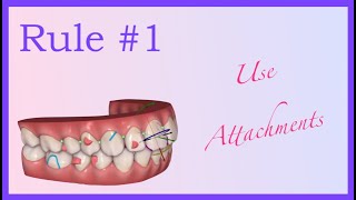 Attachments Fundamentals  Invisalign Mini Course 2 of 8 [upl. by Felton]