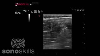 Oblique vastus medialis  MSK ultrasound pathology [upl. by Yemane]