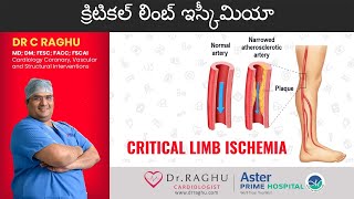 Critical limb ischemia  Gangrene  Angioplastystent  Dr C Raghu [upl. by Olegna169]