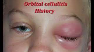 Orbital cellulitis History mrcpch Clinical [upl. by Okiron462]