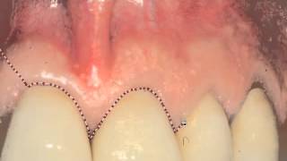 Apport du laser ErbiumYag en endodontie chirurgicale Dr David Bensoussan  Vidéo 2 [upl. by Balliett]